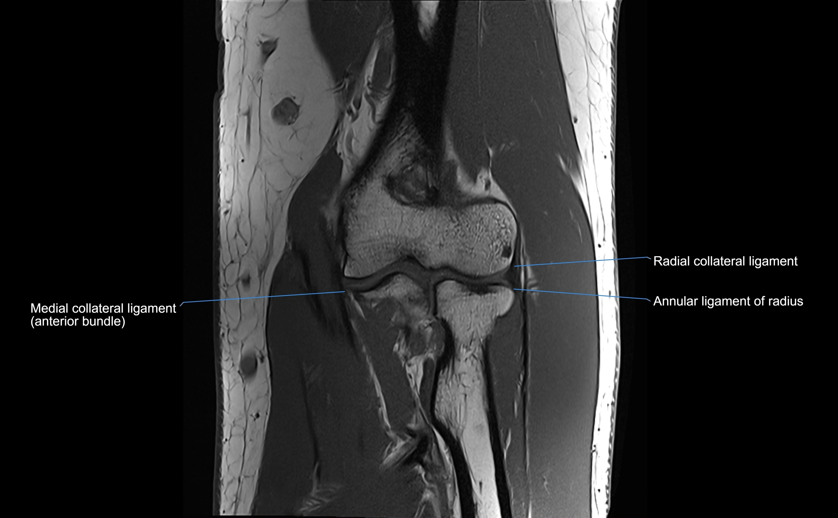 MRI elbow ligaments coronal cross sectional anatomy 3T  radiology  image-img-07001-00018.webp
